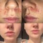 100% Natural Home Facial Kit To Heal Acne, Large, thumbnail 4 of 5