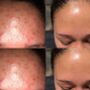 100% Natural Home Facial Kit To Heal Acne, Large, thumbnail 2 of 5